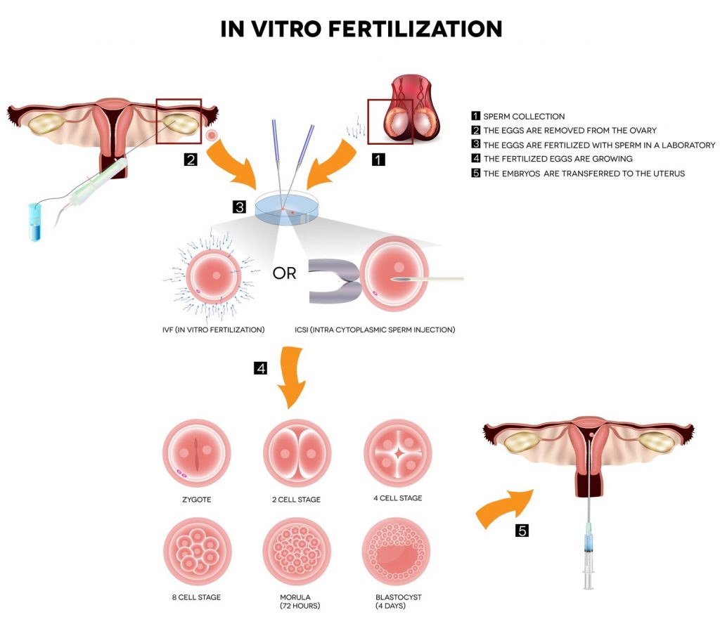 Ivf sperm donation