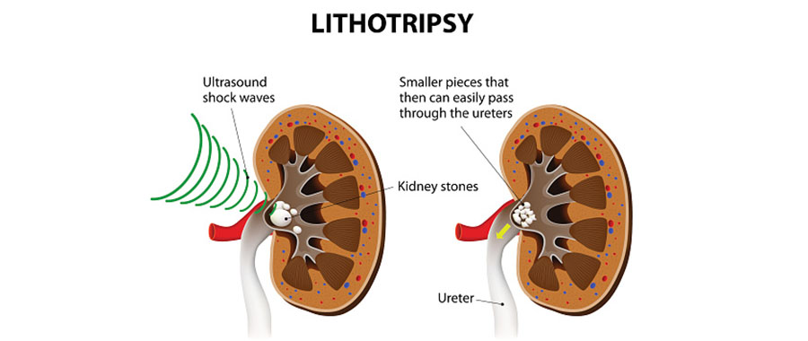 lithotripsy