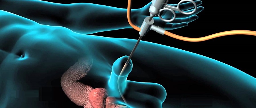 Prostate Rebore Transurethral TURP